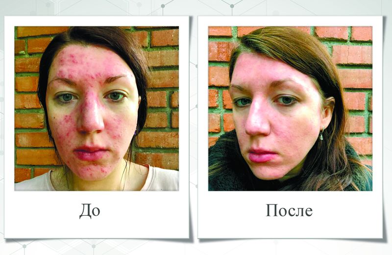hestacosmetics-evolyucionnaya-kosmetika-protiv-akne-i-ne-tolko-2